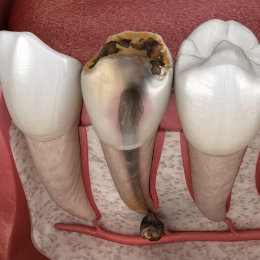 آبسه دندان چیست