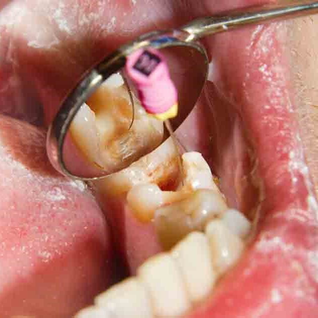 چه زمانی دندان نیاز به عصب کشی دارد