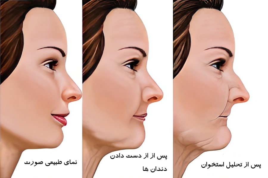 عوارض بی دندانی