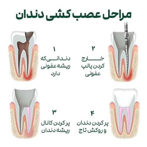 عصب کشی دندان