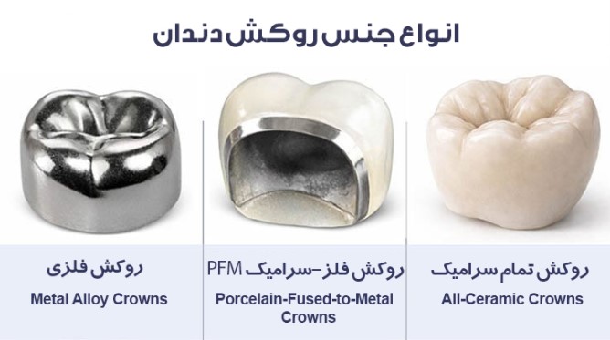 انواع روکش دندان
